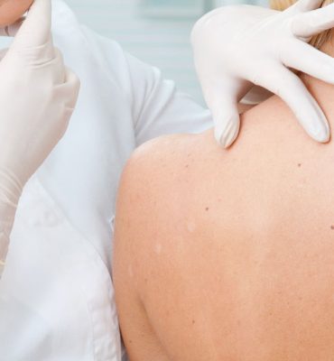 dermatólogos coruña examen lunares